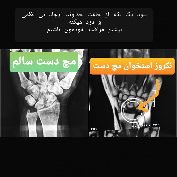 درد در مچ دست رو جدی بگیرید
