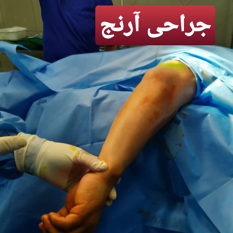 آسیب نادر در ورزشکاران به آرنج