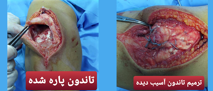 جراحی آرنج