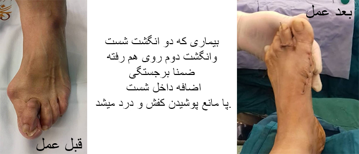 جراحی انگشت پا