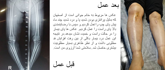 جراحی پای پرانتزی