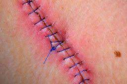 علل عفونت های بعد از عمل جراحی