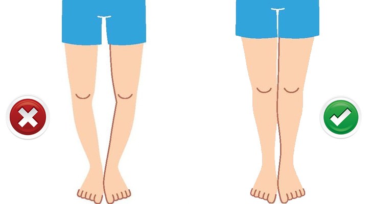 انحراف زانو چیست؟