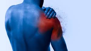 پارگی تاندون در شرایط استیف شولدر یا شانه یخ‌زده (Frozen shoulder)