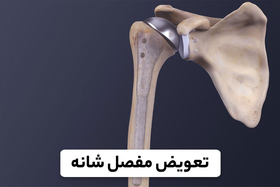 پروتز مفصل شانه، آرتروپلاستی شانه و نکات مهم پیش از جراحی