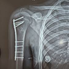شکستگی پروگزیمال هومروس،علائم، علل و روش‌ های درمان